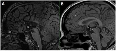 Interhemispheric Connections between the Primary Visual Cortical Areas via the Anterior Commissure in Human Callosal Agenesis